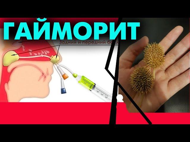 Гайморитті емдеу жолдары / #гайморит