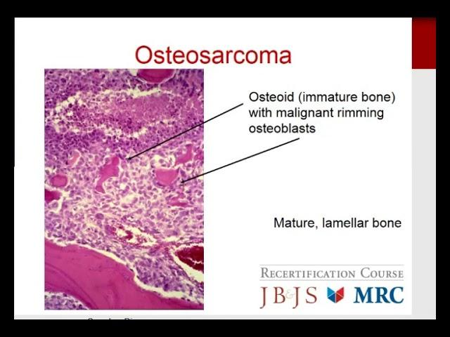 MILLER'S 2016 Orthopaedics: Orthopaedic Oncology