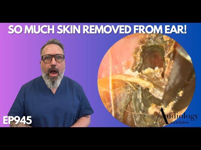 SO MUCH SKIN REMOVED FROM PATIENTS EAR CANAL - EP945