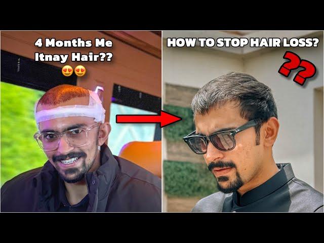 My 4 Month Hair Transplant Update & Experience @SmileHairClinic  - From Istanbul Turkey