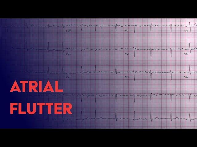 Atrial Flutter -  EKG (ECG) Interpretation