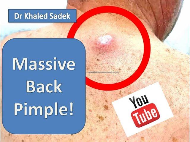 Large Sebaceous Cyst Removal. LipomaCyst.com Dr Khaled Sadek