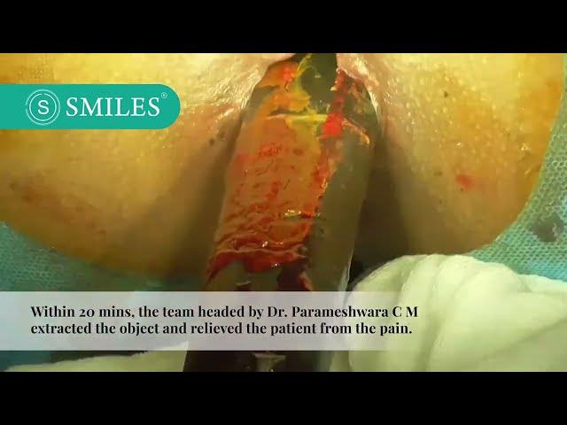 This Is Why You Should Avoid Inserting Foreign Objects Into Your Anal Canal |SMILES Gastroenterology