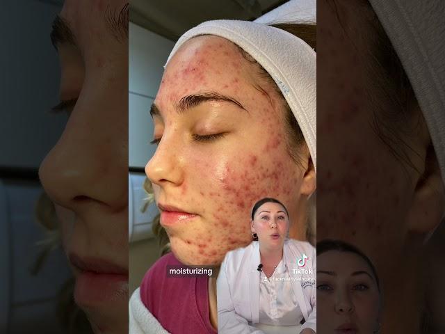 Learn about inflamed acne and the secret to treating it… an Acne Expert