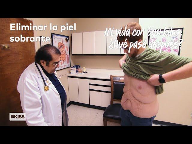 Operación para eliminar el exceso de piel | Mi vida con 300 kilos: ¿Qué pasó después?