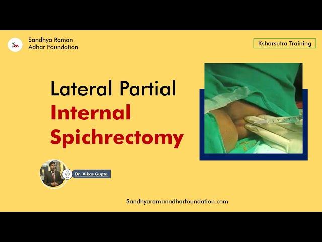 Lateral Partial Internal Spichrectomy || Dr. Vikas Gupta