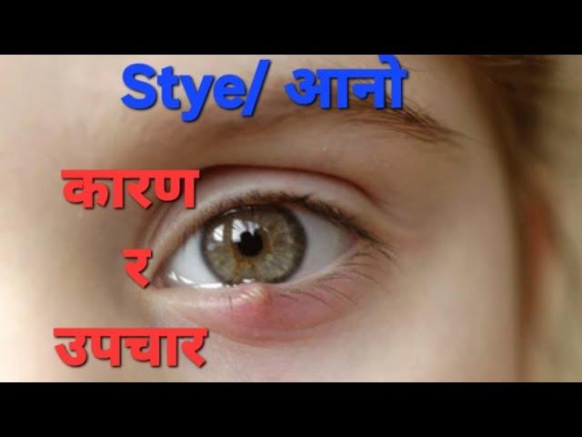 Stye/  आनो(aano) , कारण तथा घरेलु उपचार !