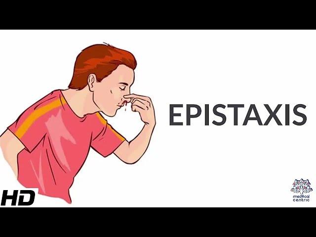 Epistaxis, Causes, SIgns and Symptoms, Diagnosis and Treatment.