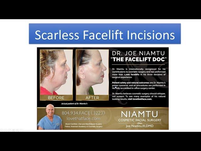 Facelift Incisions and Scars: Don't Have Facelift Surgery Without Watching This!