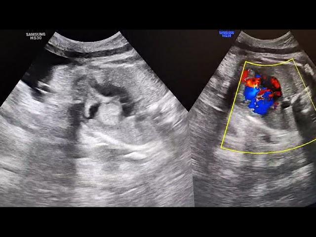 Intracardiac Tumor in fetus during pregnancy 37 weeks ?Rhabdomyoma