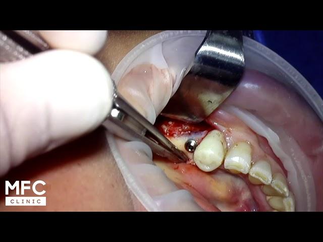 Имплантация с наращиванием костной ткани. Implantation with bone graft. 植骨植入 植入和