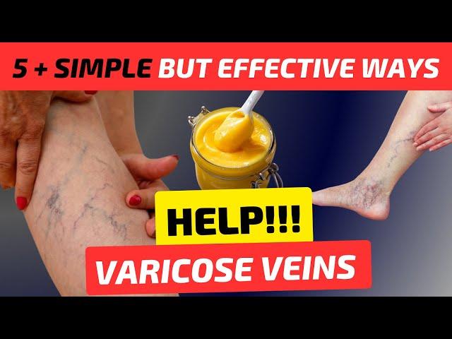 VARICOSE VEINS explained under 10 minutes | How to get rid of Varicose Veins at home?