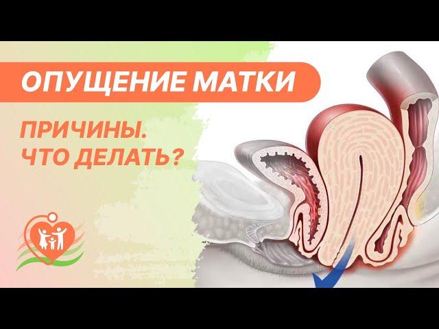 ⭕ Опущение матки. Причины. Чем грозит опущение или выпадение матки и что делать?