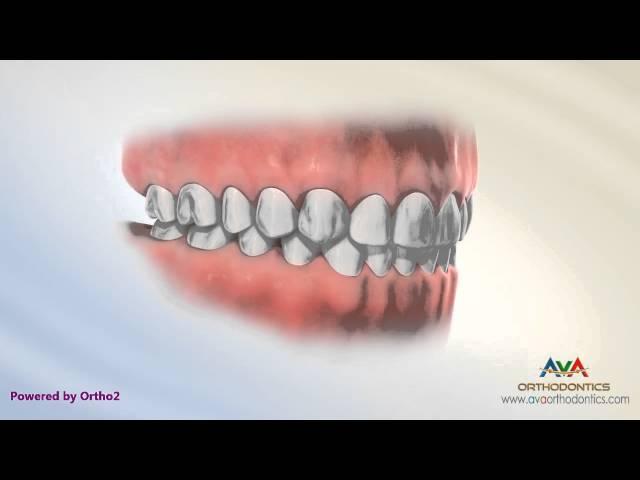 Normal Occlusion