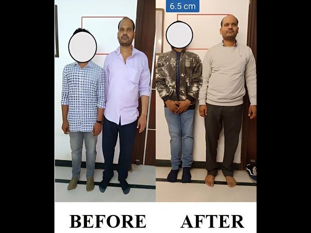 Limb Lengthening Surgery Before And After | Height Increase Surgery Before And After