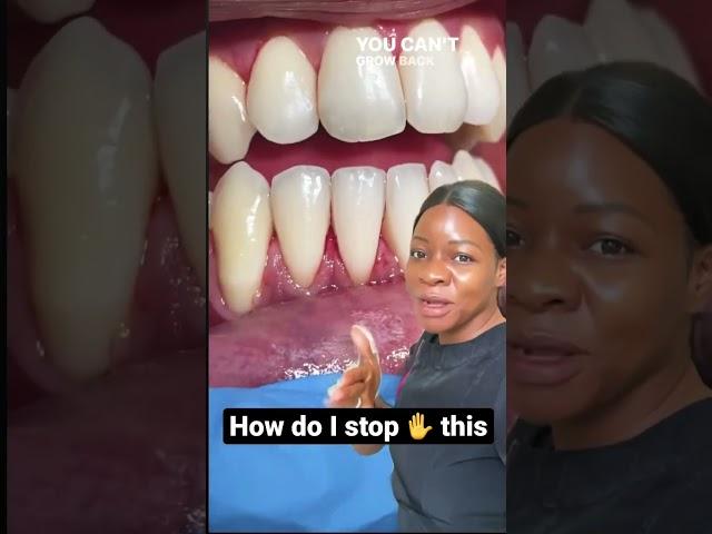 This stops gums from receding #shorts #dentist #viral #youtube #videooftheday #teeth #smile #foryou