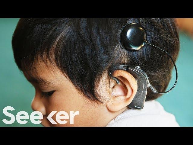 How Do Cochlear Implants Work?