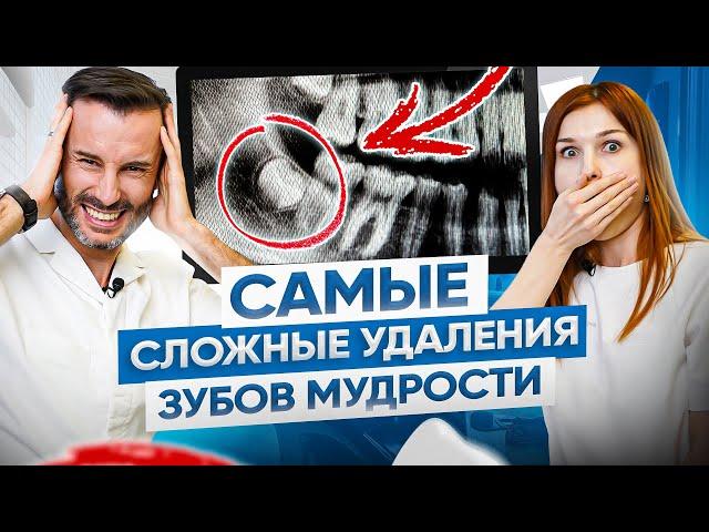 ТОП 3 самых сложных случаев удаления зубов мудрости