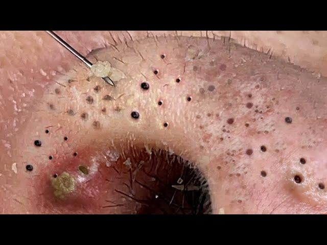 Relax squeezing out blackheads #29 Черные точки