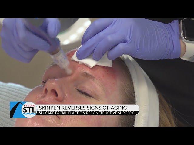 SLUCare Refresh and Reveal shows the positive results of microneedling