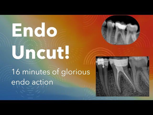 GentleWave root canal on a pediatric patient | Endo Uncut