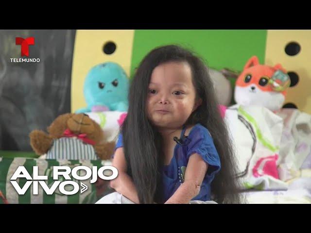 Una colombiana podría llevar el título de la mujer más pequeña por una enfermedad genética