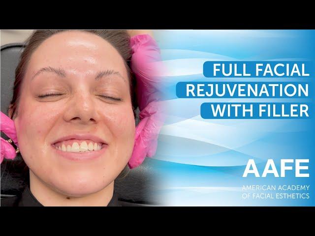 Full Facial Rejuvenation with Filler