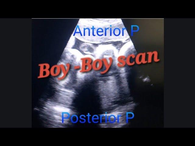 Boy-Boy Scan @ anterior & posterior Placenta | Genderreveal Fraternal Twins | Diamniotic Dichorionic