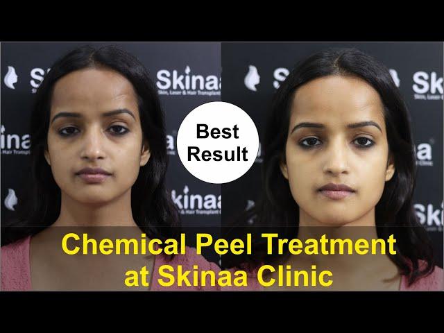 Take Advantage Of Chemical Peel Treatment at Skinaa Clinic