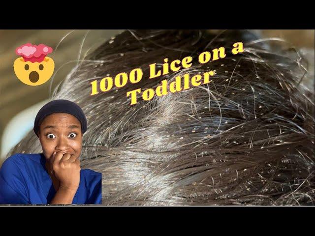 Lice Treatment for a Crying Toddler | 1000+ Head Lice Infestation | Millions and Millions Of Lice