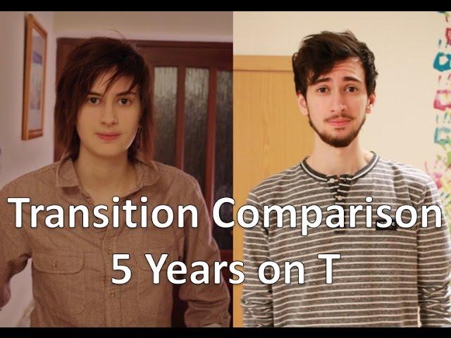 FTM Transgender: 5 Years on Testosterone Comparison