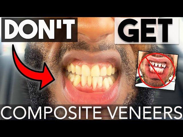 DON'T GET COMPOSITE VENEERS! *UNTIL YOU WATCH THIS* | Composite vs. Porcelain Veneers | COOPSCORNER