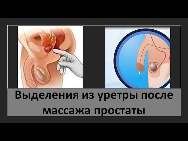 Выделения из уретры после массажа простаты