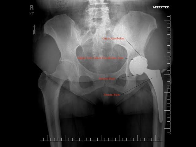 What is a Hip Replacement? Dr. Robert Cagle Explains