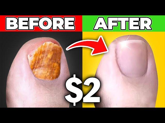 Get Rid Of Toenail Fungus for Good for Only $2.00