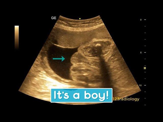 Ultrasound showing boy baby !!!