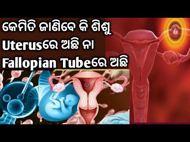 କେମିତି ଜାଣିବେ ଶିଶୁ Uterus ରେ ଅଛି ନା FallopianTube ରେ ଅଛି।Early Pregnancy Symptoms।Ectopic Pregnancy