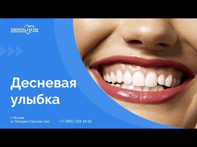  Десневая улыбка. Как исправить десневую улыбку?