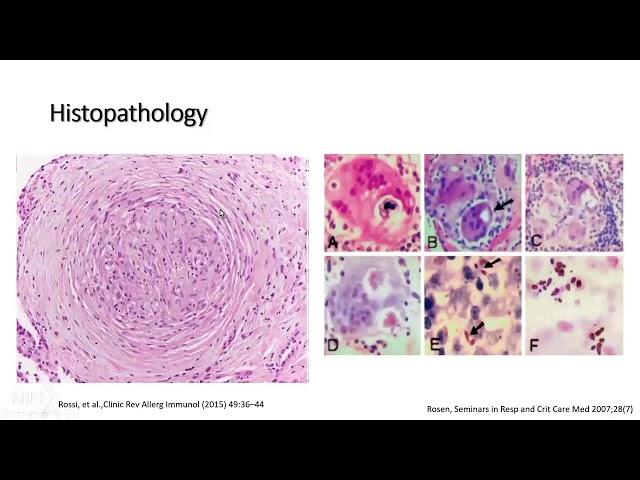 Sarcoidosis