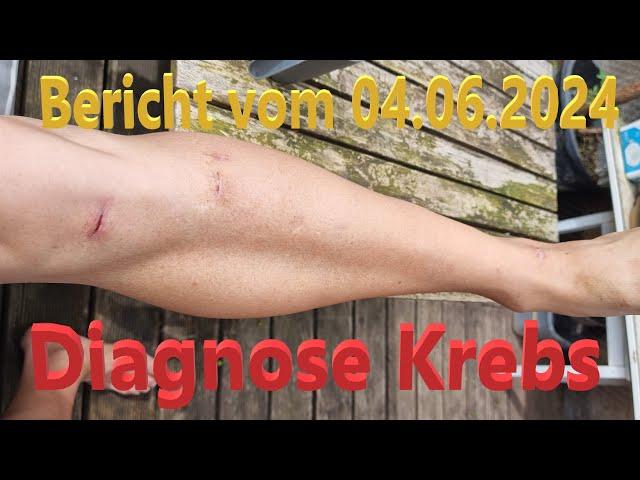 Diagnose KREBS - Bericht vom 05.06.2024