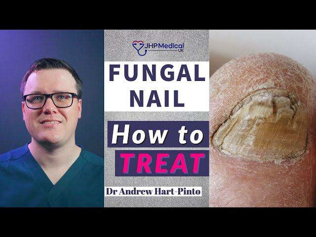 How to TREAT Fungal Nail | Get Rid Of Nail Fungus |Anti-Fungal Lacquer & Tablets