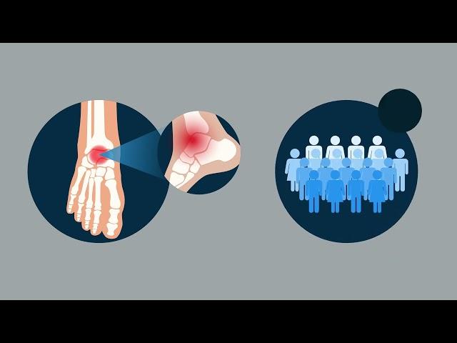 Ten-Year Survival Rate of 82% in 262 Cases of Arthroscopic Bone Marrow Stimulation for Osteochondral