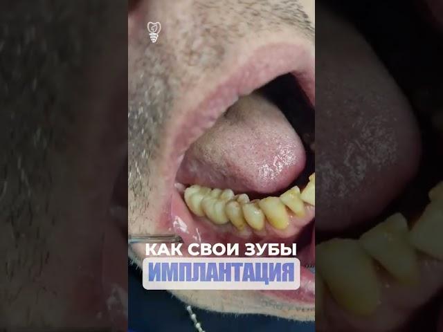 Как свои зубы. Identical teeth. Implantation.