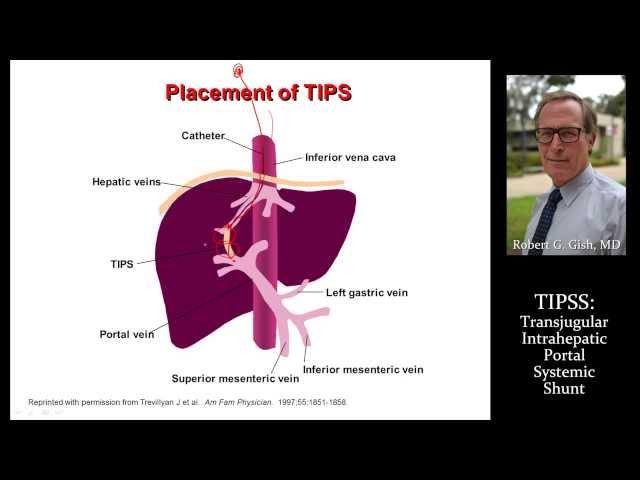 TIPSS by Dr. Robert Gish