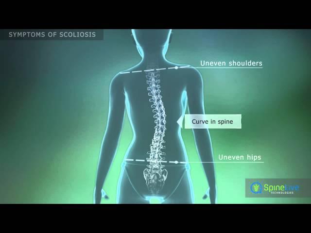 Scоliosis Symptoms