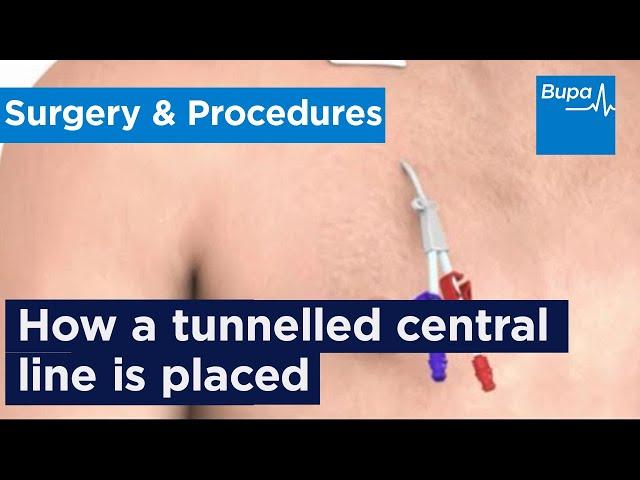 How a tunnelled central line is placed | Bupa Health