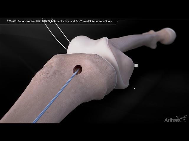 BTB ACL Reconstruction With BTB TightRope® Implant and FastThread™ Interference Screw