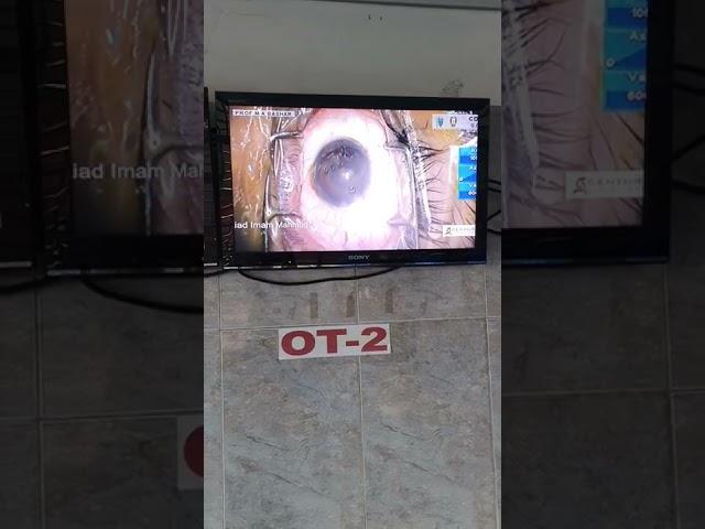 Congenital Posterior  Polar cataract surgery  at LE