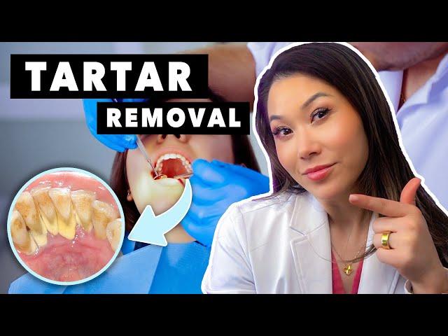 What is Tartar and How to Remove it