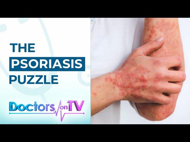 Psoriasis: Know the Symptoms, Causes, and available Treatments from Dermatology Specialist